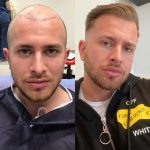 hair transplants in Turkey