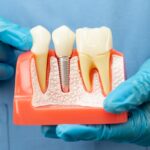 Teeth Implants Abroad -- What You Need To Know