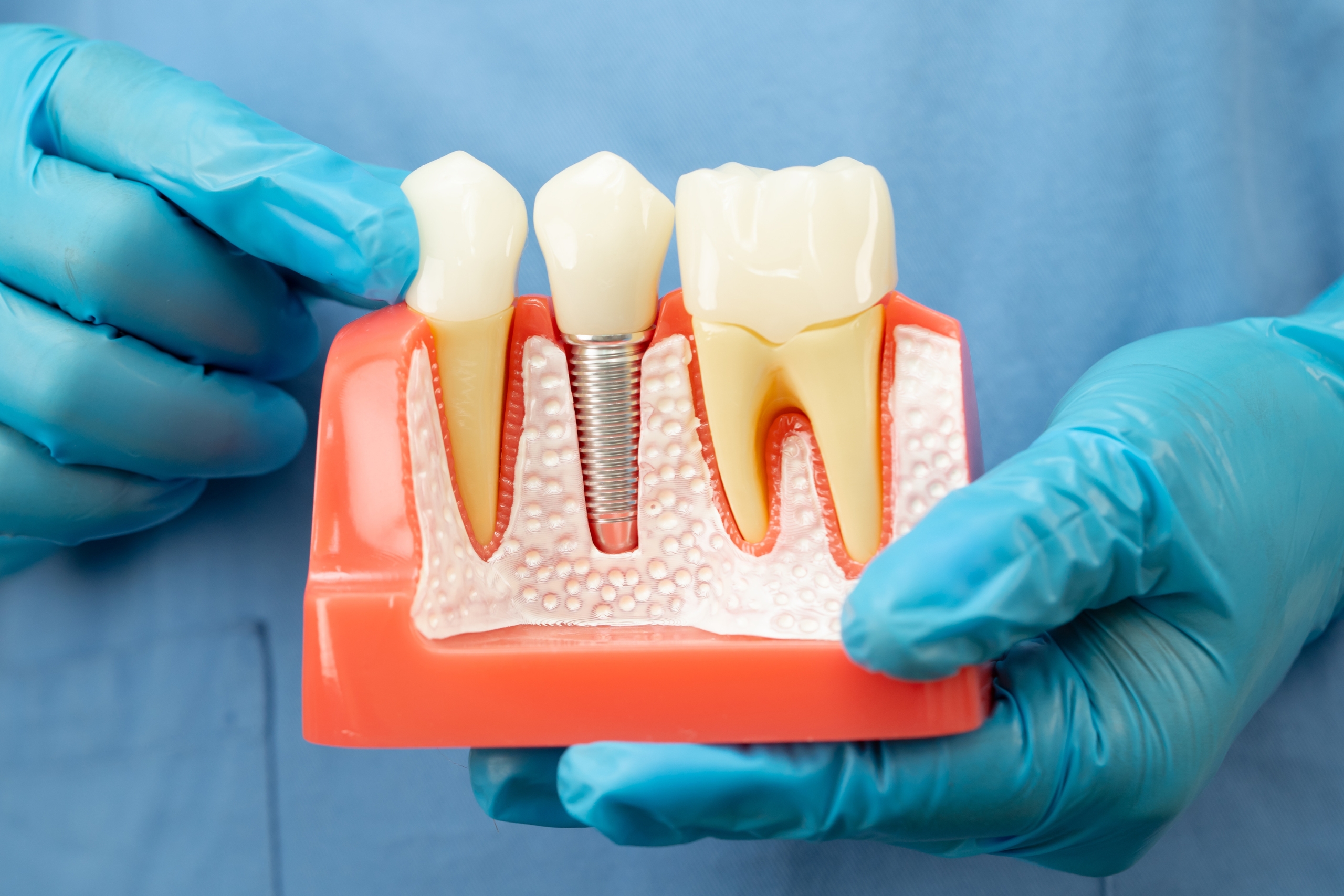 Teeth Implants Abroad -- What You Need To Know
