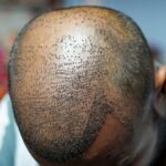 How Turkey Became the Global Capital Of Hair Transplants In 2022