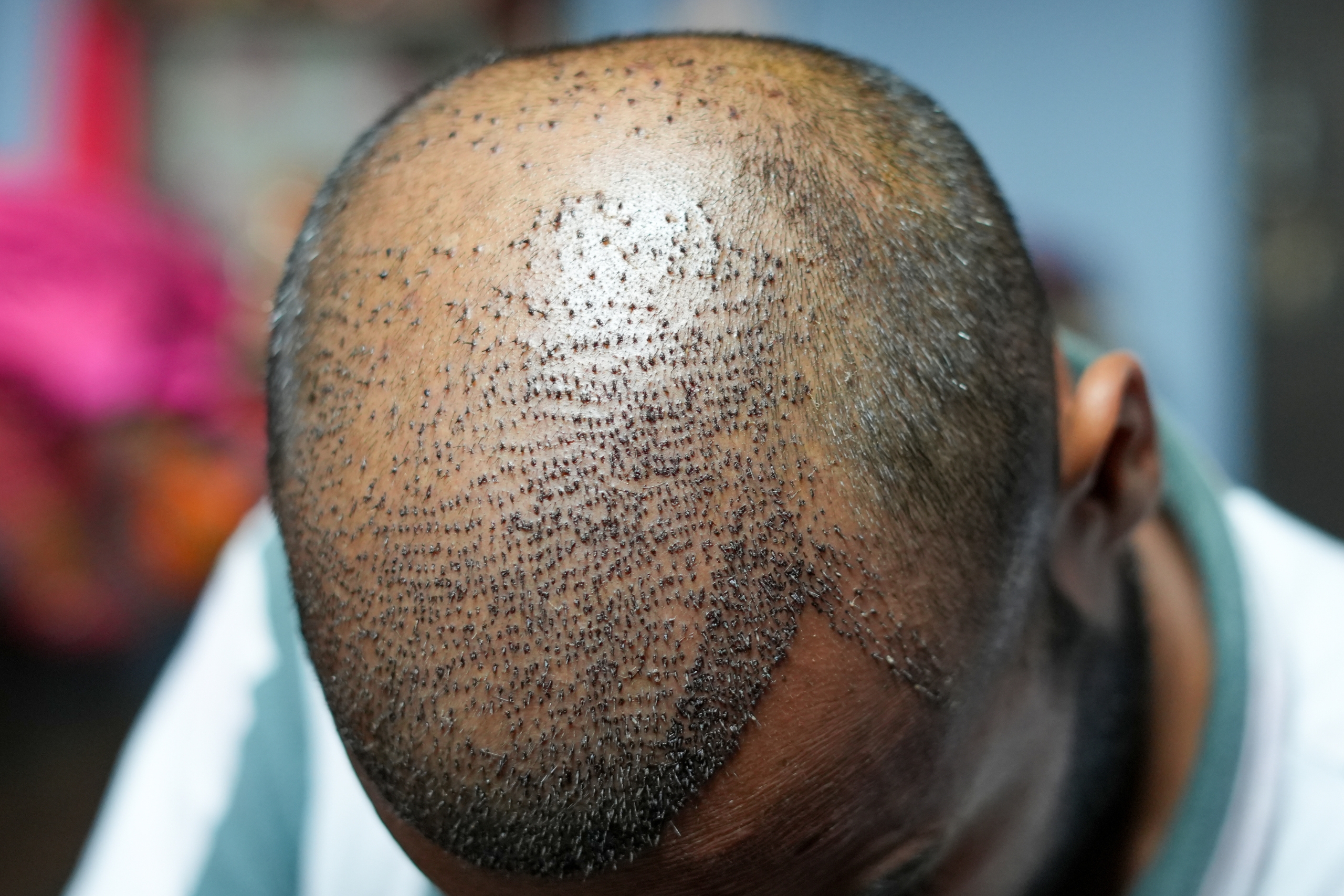 How Turkey Became the Global Capital Of Hair Transplants In 2022
