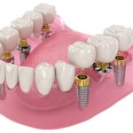 Oral Implants Abroad The Cheapest Countries to possess Dental Implants