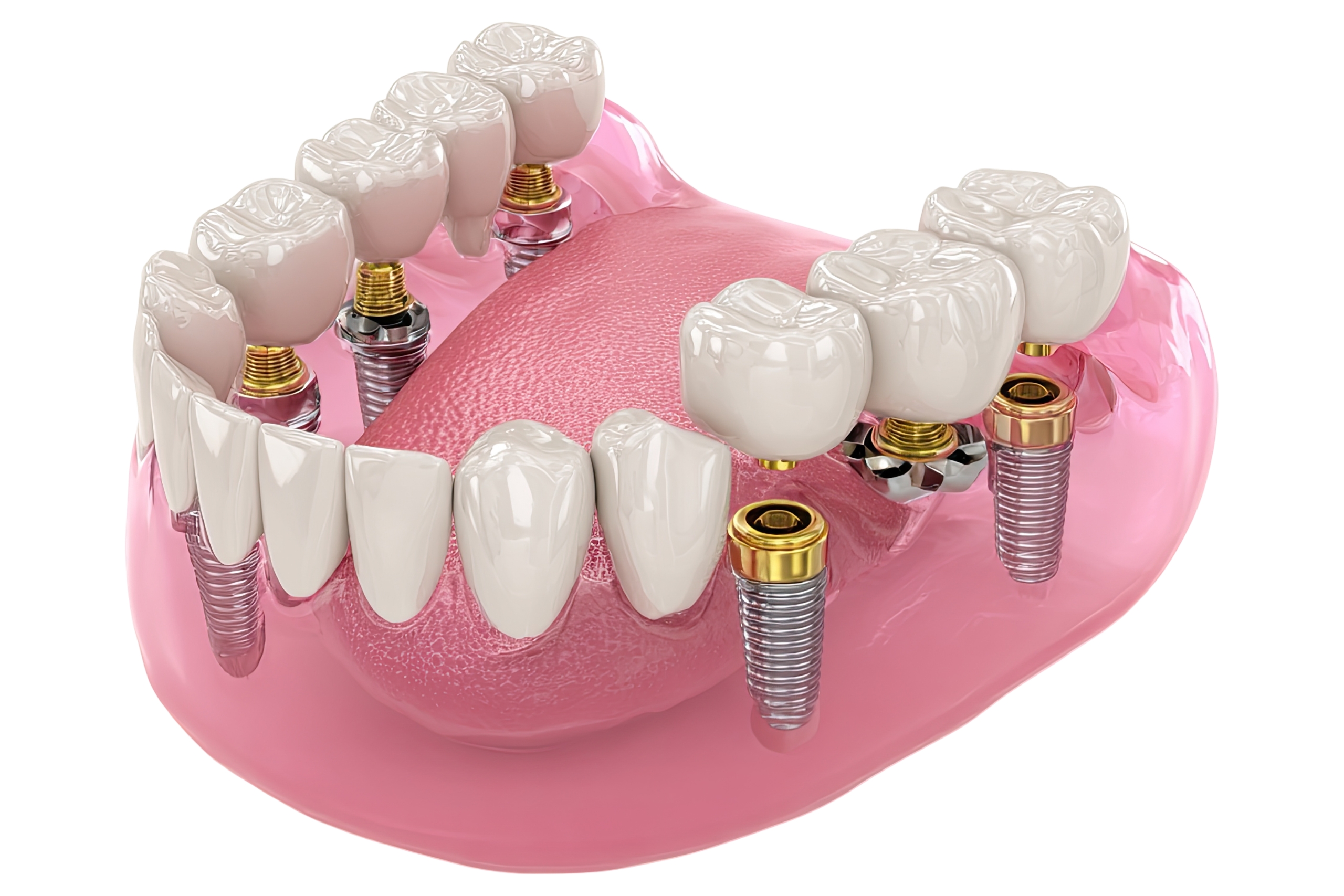 Oral Implants Abroad The Cheapest Countries to possess Dental Implants