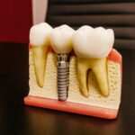 Dental care Implants – In the event you Go Abroad Intended for Dental Implants?