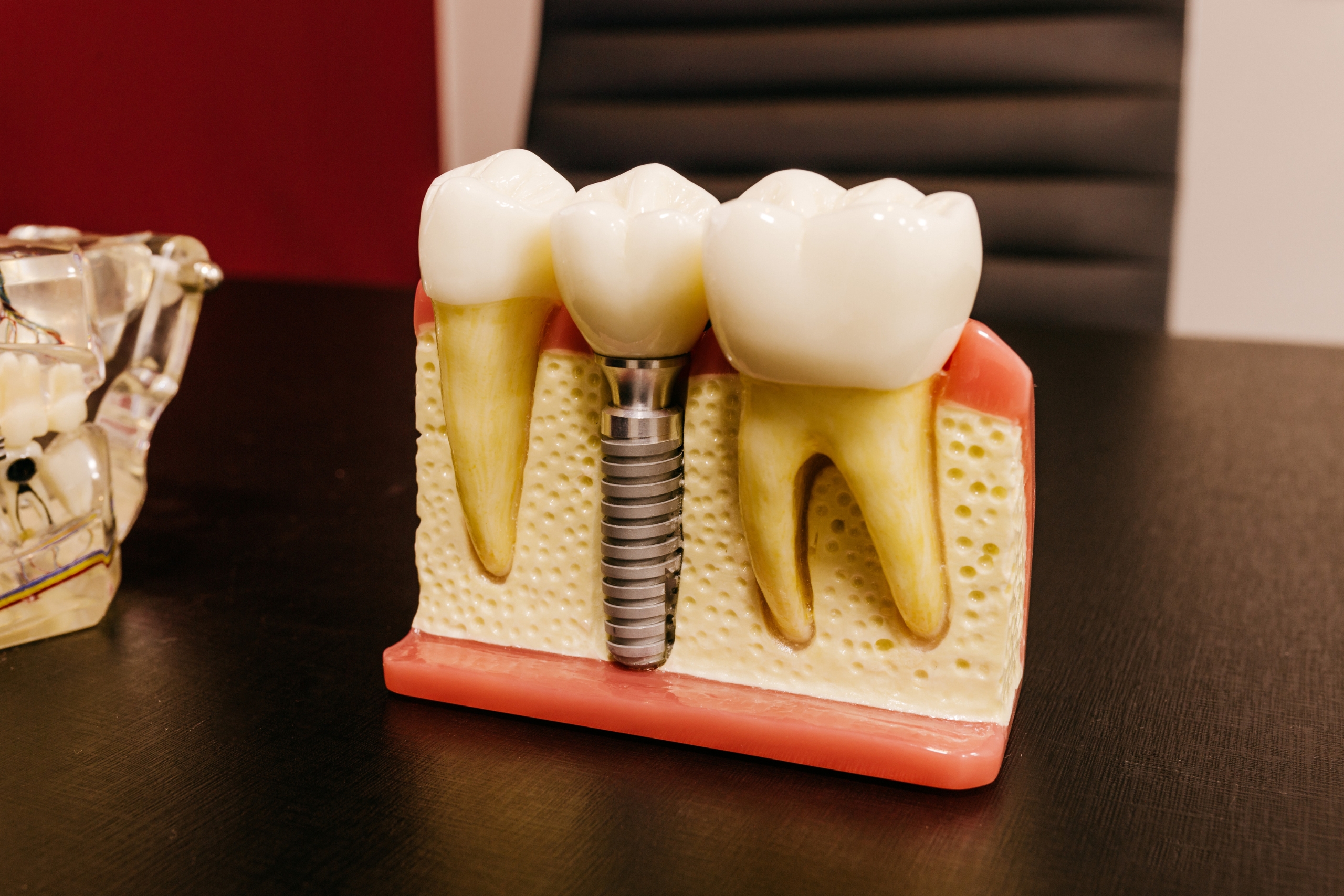 Dental care Implants – In the event you Go Abroad Intended for Dental Implants?